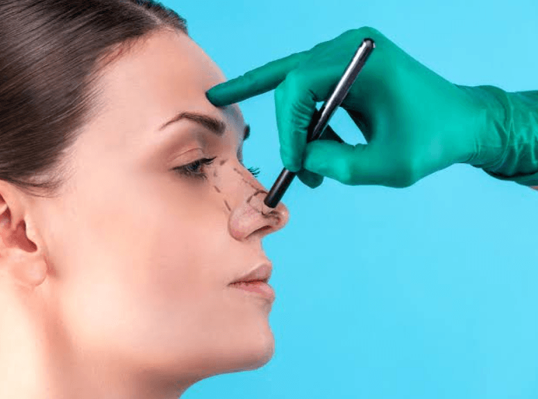 Rhinoplasty Nose