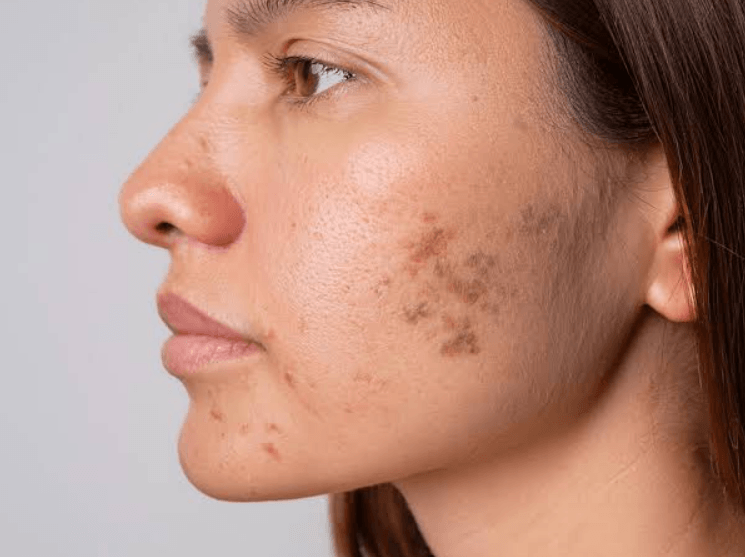 Hyperpigmentation