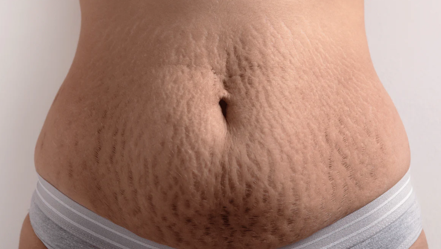 Stretch Marks Therapy