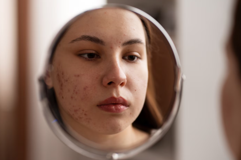 ACNE & SCARS