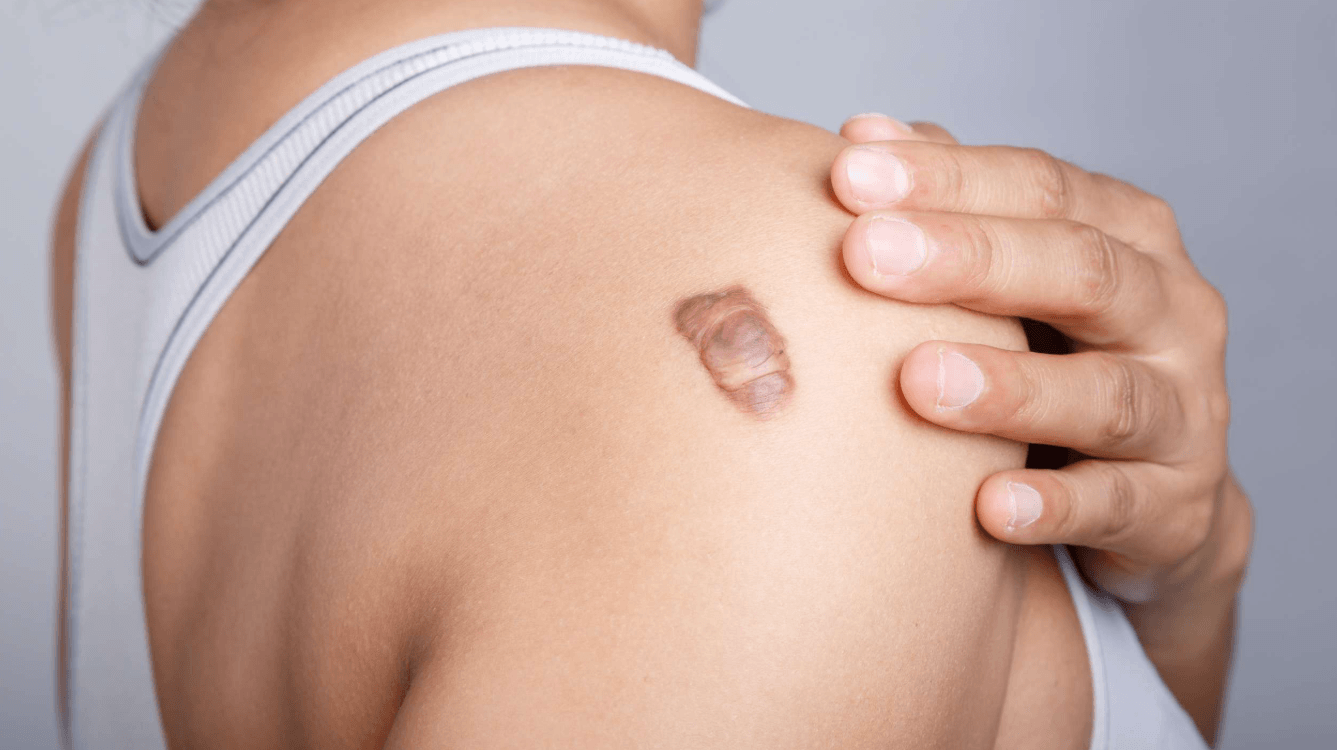 Keloid Scar