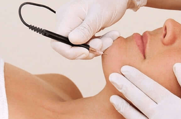 Electrolysis for white hair